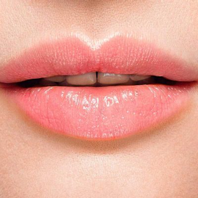 lippenvergrosserung-nachher